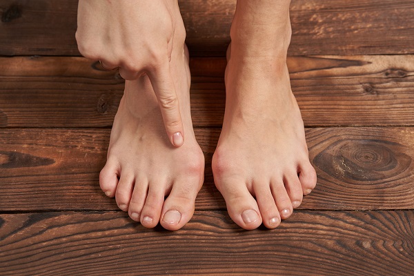 Proč je vbočený palec velkým problémem našich nohou?